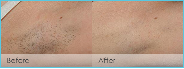 Laser Hair Removal Before and After Picture Texas 