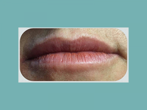 Juvederm® Before and After Pictures San Antonio and Boerne, TX