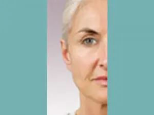 Juvederm® Before and After Pictures San Antonio and Boerne, TX