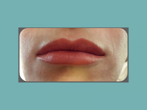 Juvederm® Before and After Pictures San Antonio and Boerne, TX