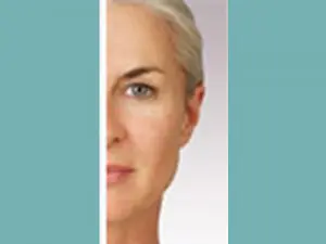 Juvederm® Before and After Pictures San Antonio and Boerne, TX