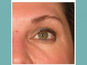Ultherapy Before and After Pictures San Antonio and Boerne, TX