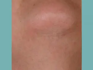 Laser Hair Removal Before and After Pictures San Antonio and Boerne, TX