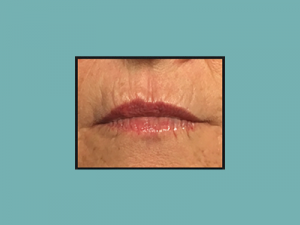 Juvederm® Before and After Pictures San Antonio and Boerne, TX