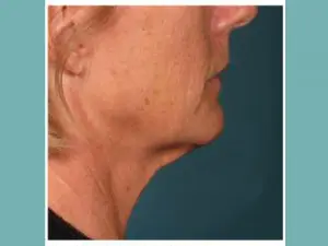 Ultherapy Before and After Pictures San Antonio and Boerne, TX