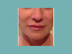 Juvederm® Before and After Pictures San Antonio and Boerne, TX