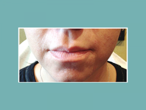 Juvederm® Before and After Pictures San Antonio and Boerne, TX