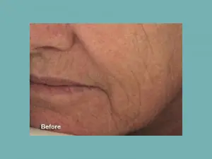 Pearl Fractional Before and After Pictures San Antonio and Boerne, TX