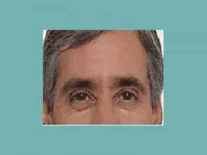 Botox Before and After Pictures San Antonio and Boerne, TX
