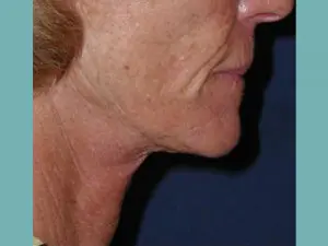 Titan Skin Tightening Before and After Pictures San Antonio and Boerne, TX