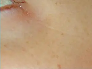 Laser Genesis Before and After Pictures San Antonio and Boerne, TX