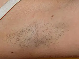 Laser Hair Removal Before and After Pictures San Antonio and Boerne, TX