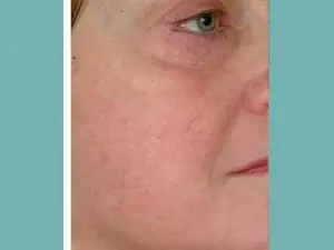 Spider Vein Treatment Before and After Pictures San Antonio and Boerne, TX
