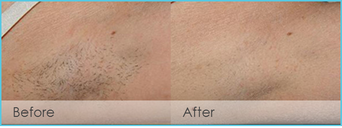 Laser Hair Removal in Kerrville, TX