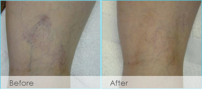 Spider Vein Treatment Before and After Pictures Kerrville, TX