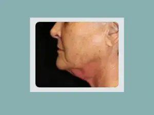 Kybella® Before and After Pictures San Antonio and Boerne, TX