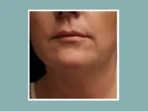 Kybella® Before and After Pictures San Antonio and Boerne, TX
