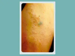 Tattoo Removal Before and After Pictures San Antonio and Boerne, TX