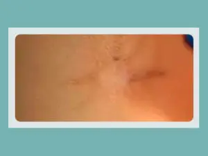 Tattoo Removal Before and After Pictures San Antonio and Boerne, TX
