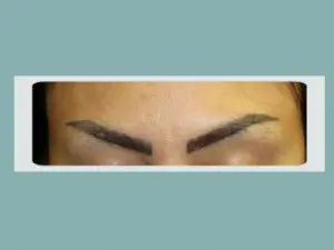 Tattoo Removal Before and After Pictures San Antonio and Boerne, TX