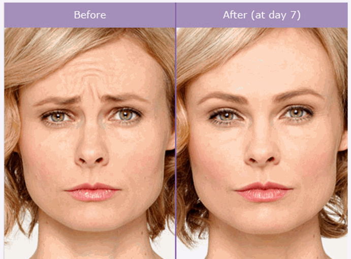 Botox Before and After Pictures San Antonio and Boerne, TX
