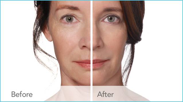 Radiesse Before and After Pictures San Antonio and Boerne, TX