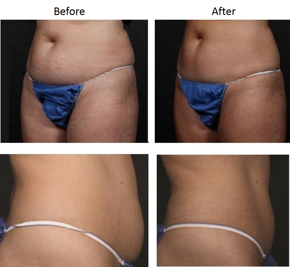 truSculpt Before and After Pictures San Antonio and Boerne, TX