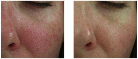 Clear and Brilliant Fraxel Laser Before and After Pictures San Antonio and Boerne, TX