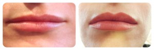 Juvederm Before and After Pictures San Antonio and Boerne, TX
