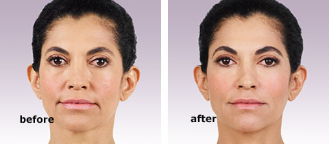Juvederm Before and After Pictures San Antonio and Boerne, TX