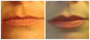 Juvederm Before and After Pictures San Antonio and Boerne, TX