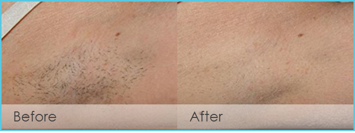 Laser Hair Removal Before and After PicturesBoerne, TX 