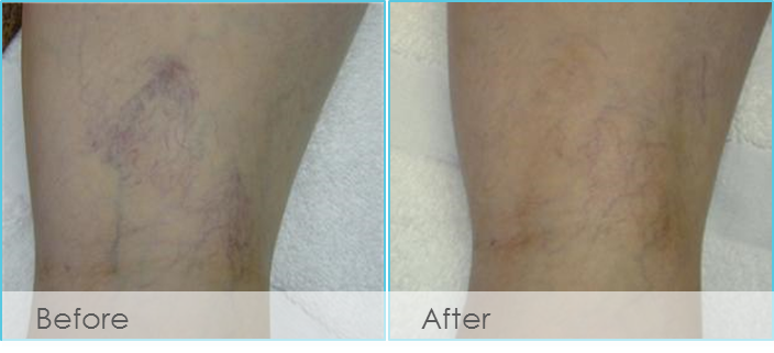 Spider Vein Treatment Before and After Pictures Fredericksburg, TX 