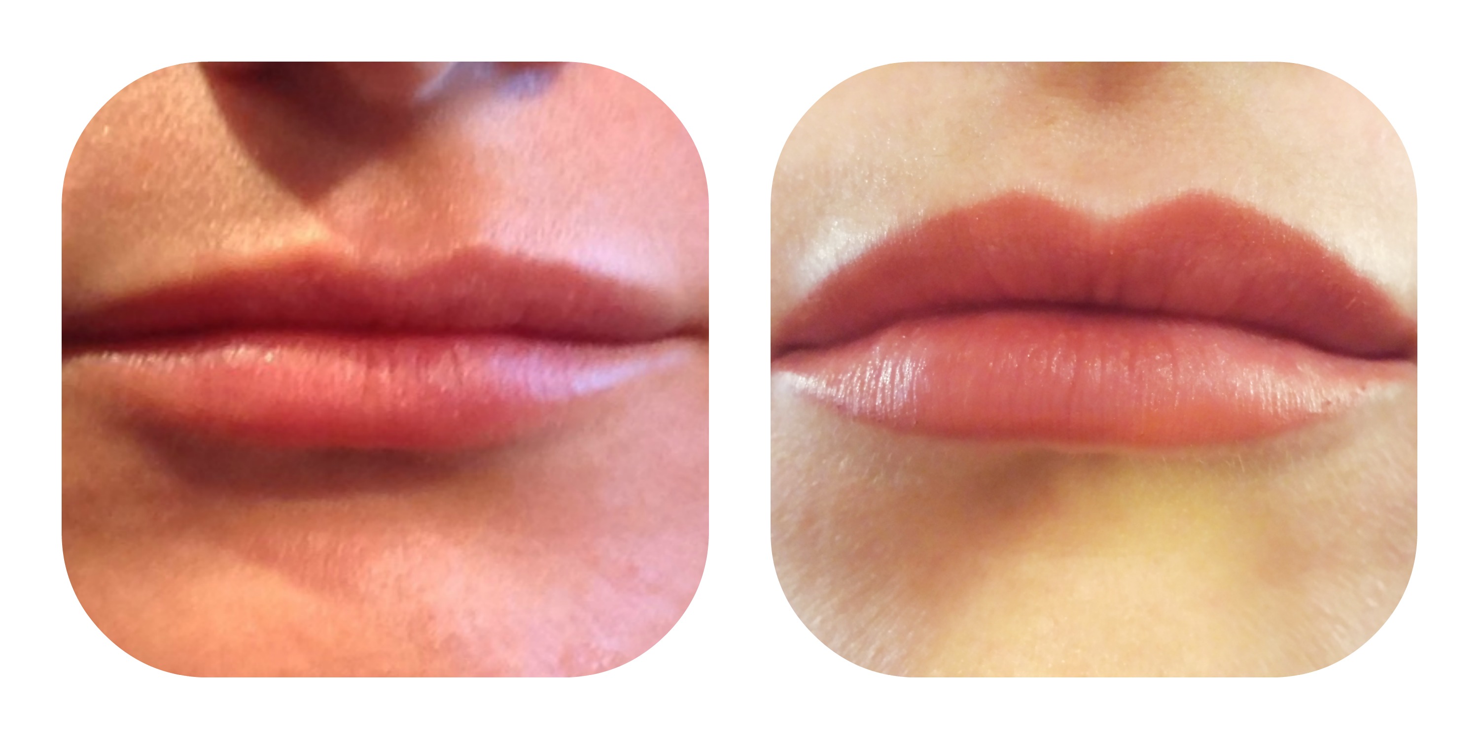 The Youthful Improvement Seen With Augmenting Lips at Any Age