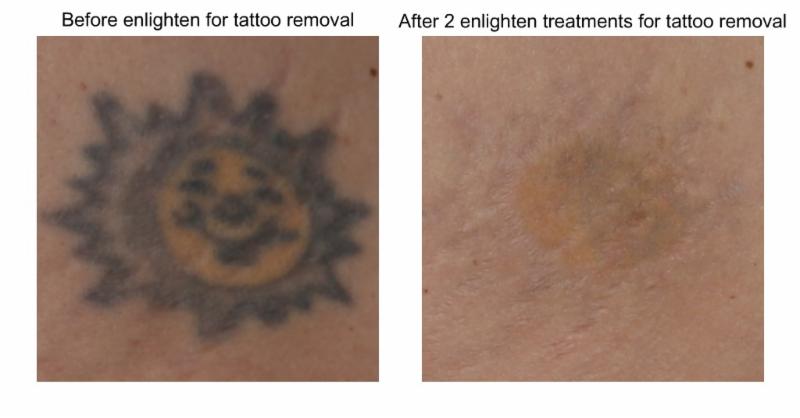 Tattoo Removal Before and After Pictures San Antonio and Boerne, TX