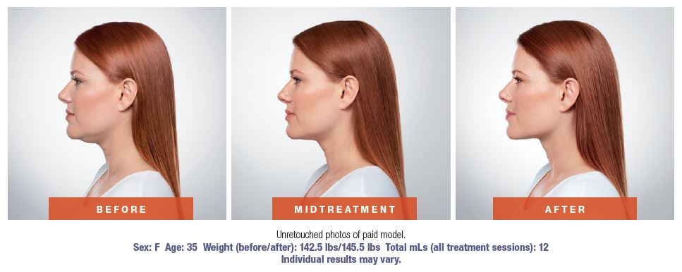 Kybella™ in San Antonio and Boerne, TX