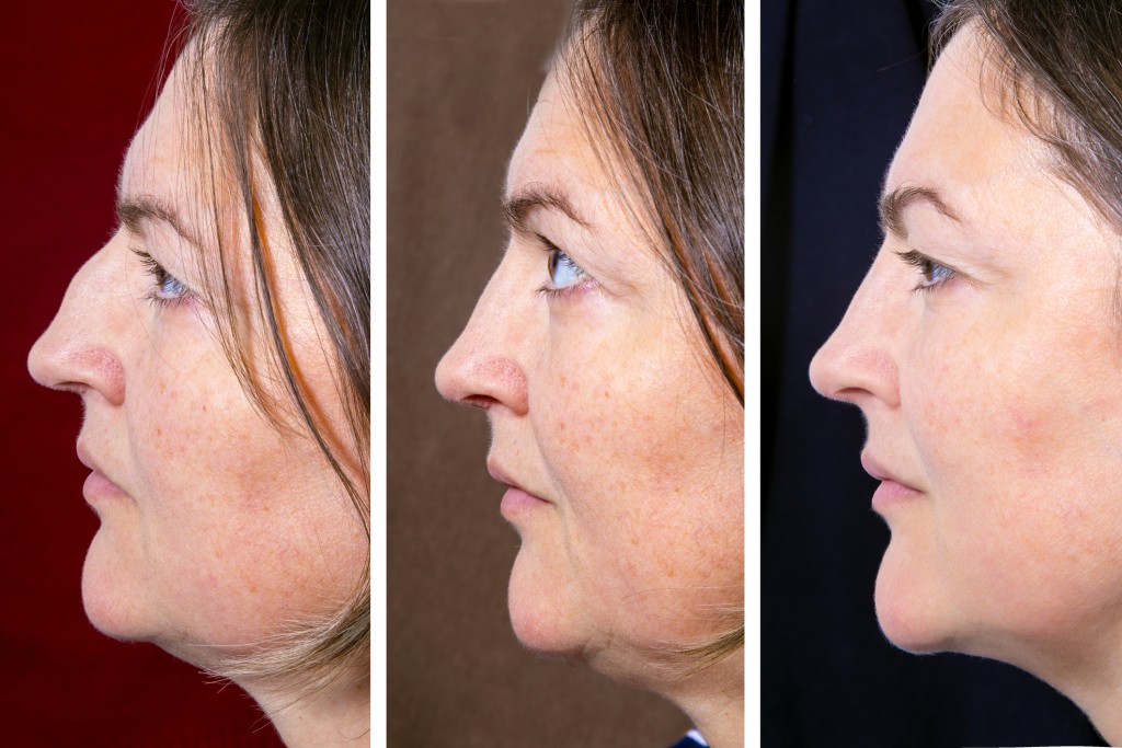 Kybella® Before and After Pictures San Antonio and Boerne, TX
